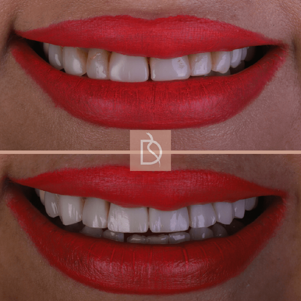 Farah before and after composite bonding