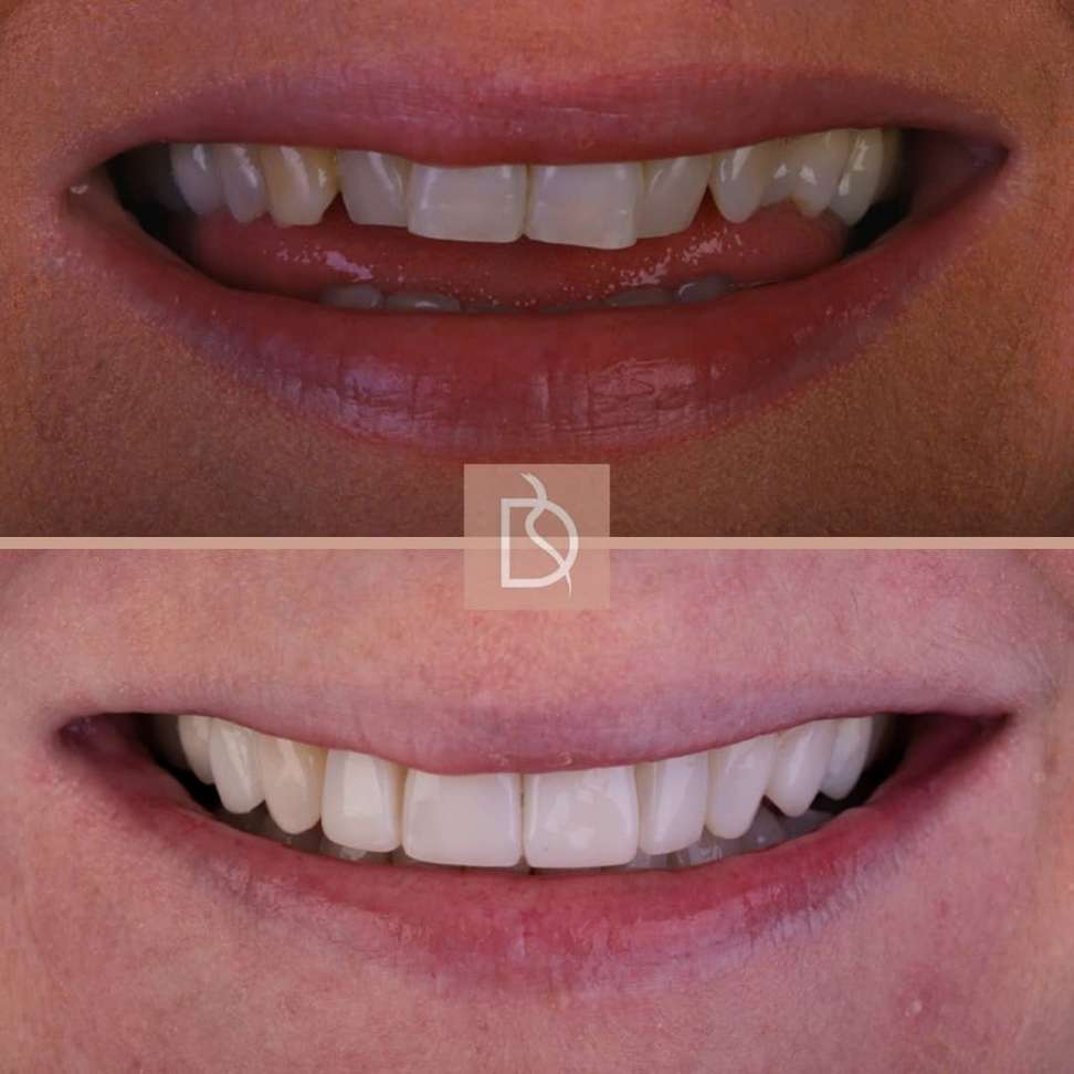 Louise before and after
